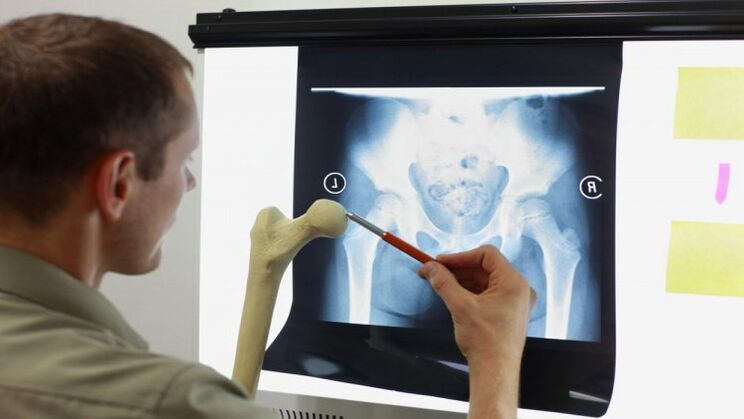 Doctor examines an x-ray for hip arthrosis